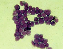 Tìm ra bản đồ gene của bệnh ung thư